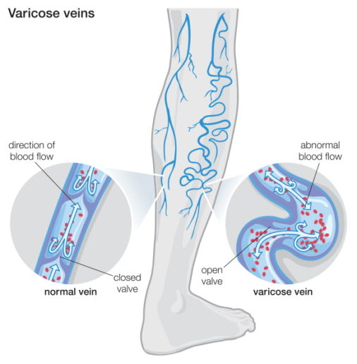 Suffer From Varicose Veins? Oceana Vein Specialists Can Help!