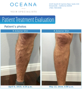 varicose vein treatment before and after