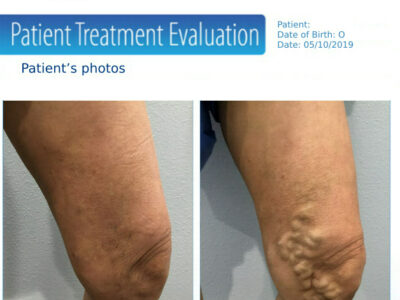 How Much Does Varicose Vein Treatment Cost? Thumbnail