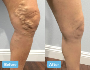 Before and after varicose vein treatment