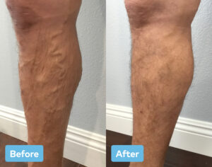 Before and after varicose vein treatment