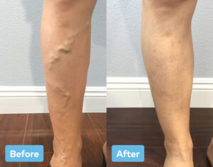 Before and after varicose vein treatment