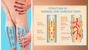 Understanding Vein Specialists