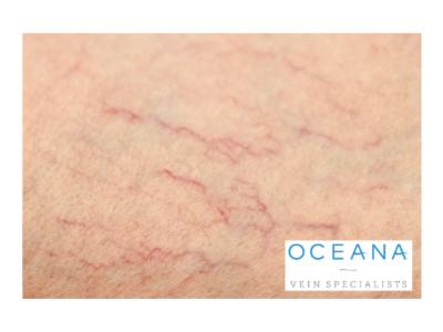 How Much Does Spider Vein Sclerotherapy Cost? Thumbnail