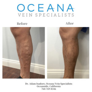 Treatment Options for Varicose Veins in Oceanside