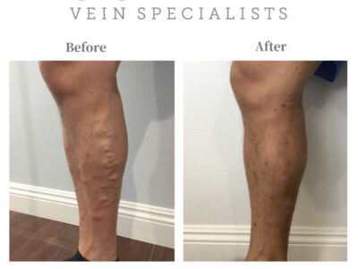 Treatment Options for Varicose Veins in Oceanside Thumbnail