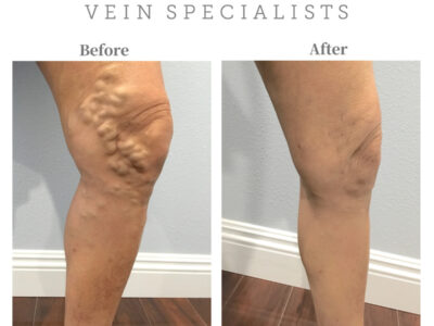 Top 5 Reasons to Seek Treatment for Varicose Veins Thumbnail