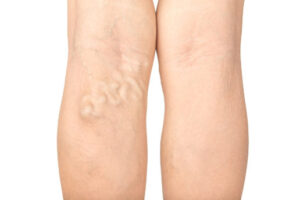 Understanding Varicose Veins: How They Form in Your Legs