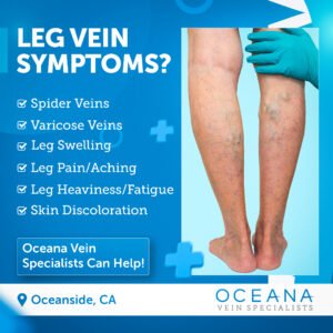 Do You Need Vein Treatment? Signs and Symptoms to Watch For