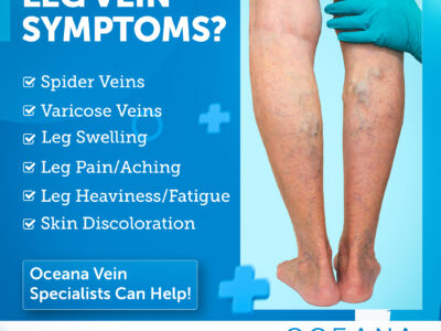 Do You Need Vein Treatment? Signs and Symptoms to Watch For Thumbnail