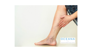 Spider Vein Sclerotherapy Oceanside