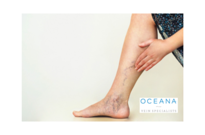 Spider Vein Sclerotherapy: Your Solution to Healthy and Beautiful Legs Thumbnail